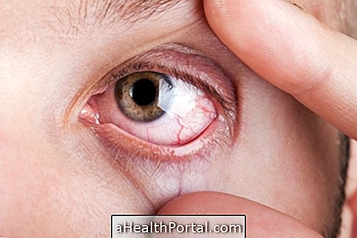 Visste du at Rheumatoid arthritis kan påvirke øynene?