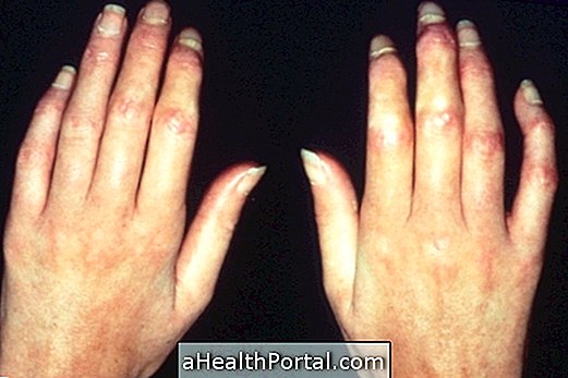 How to Identify and Treat Scleroderma