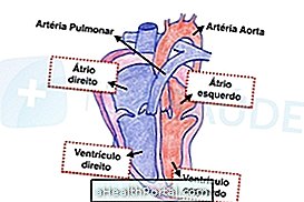 What is dextrocardia and major complications