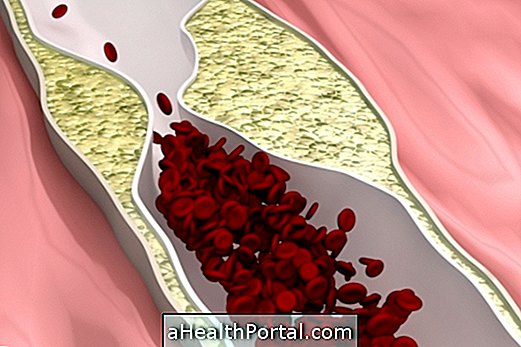 Koronaarne südamehaigus: mis see on ja selle sümptomid