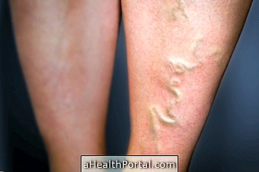 Phlebitis Symptoms and How Treatment Is Done