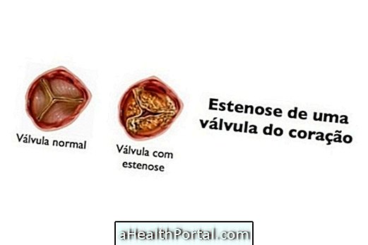 Aortan stenoosi: mitä se on, oireet ja hoito