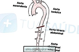 Kuidas teada saada, kas mul on aordi aneurüsm