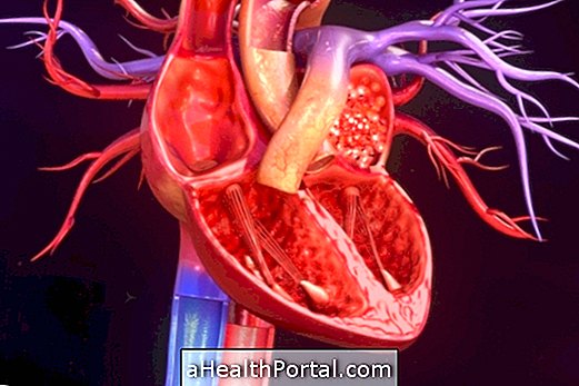 Symptomer på diabetisk kardiomyopati og hvordan man behandler det