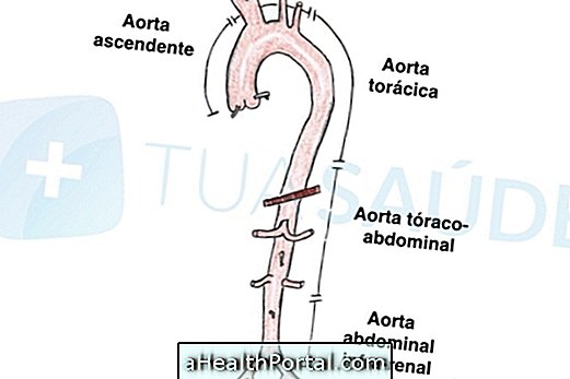 Symtom, orsaker och behandling av aorta-aneurysm