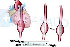 Behandling for aorta aneurisme