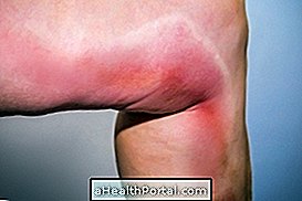 What is thrombophlebitis and its causes