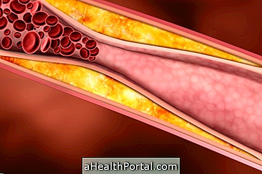 สาเหตุสำคัญของหลอดเลือดแดง Atherosclerosis