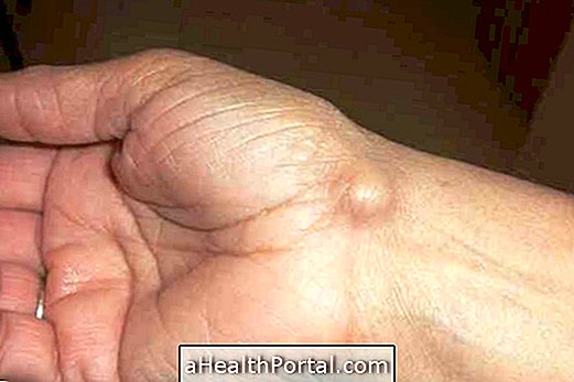Sebaceous cyste kan være på huden.