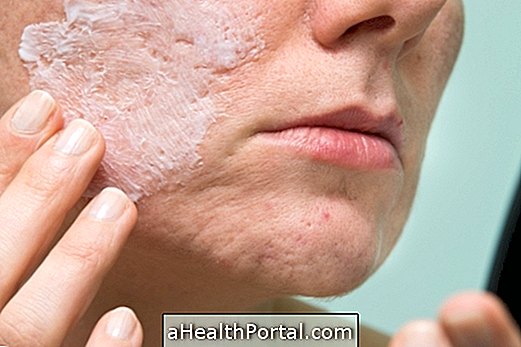 Vitacid Acne Gel: How to Use and Possible Side Effects