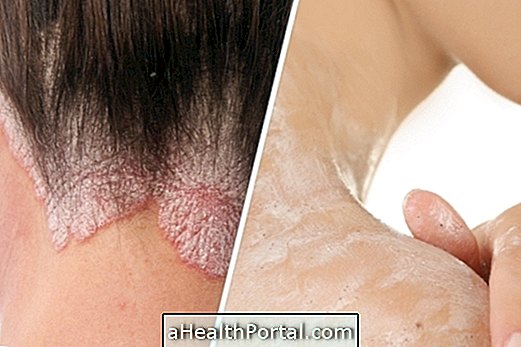 Does psoriasis have a cure?