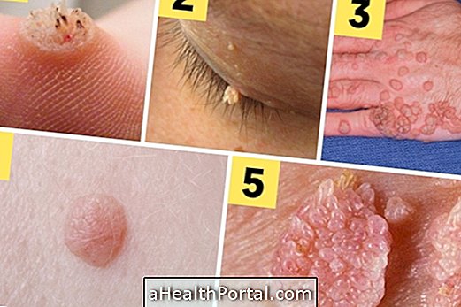 Top Types and Treatments for Warts
