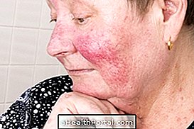 ādas slimības - Kas ir rozāāceja, simptomi, veidi, cēloņi un ārstēšana