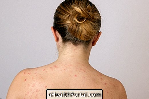 Hvad forårsager og hvordan man behandler acne på bagsiden