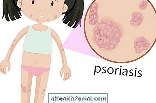 Guttate Psoriasis: oireet ja hoito