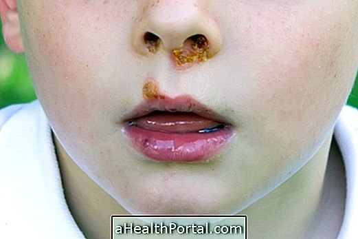 What is Impetigo, its causes and transmission
