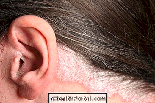 Rawatan psoriasis pada kulit kepala