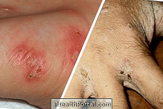 How to Identify and Treat Scabies