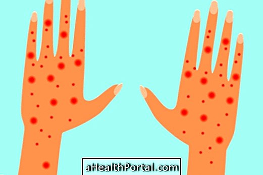 Symptoms of human scabies and how to treat