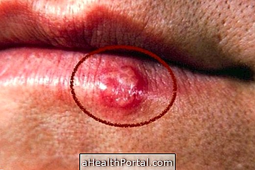 Learn how to get caught and how to protect yourself from Herpes