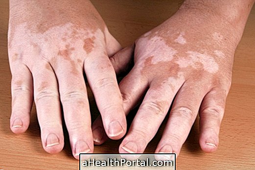 Was kann Vitiligo verursachen und wie es zu behandeln ist