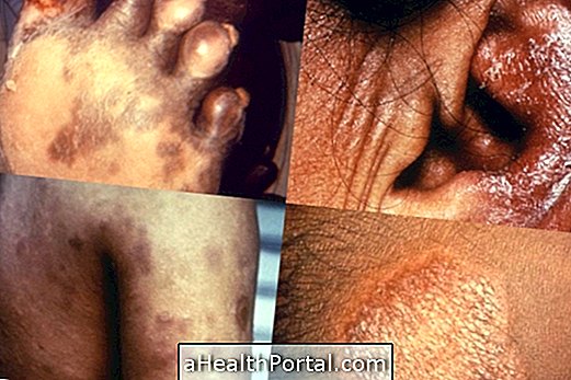Tünetek és a Leprosy Sticks