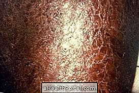 Exfoliatiivne dermatiit: mis see on, sümptomid ja kuidas seda ravida