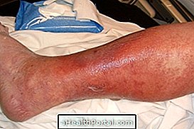 Hautinfektion: Arten, Symptome und Behandlung