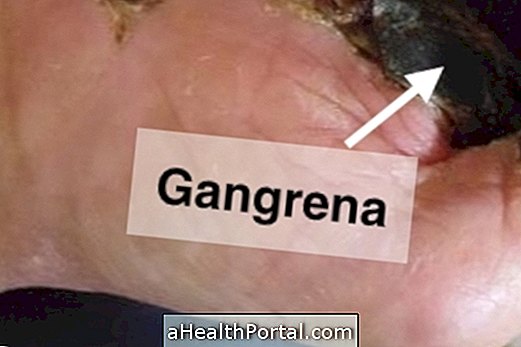 What is gangrene, symptoms and how to treat