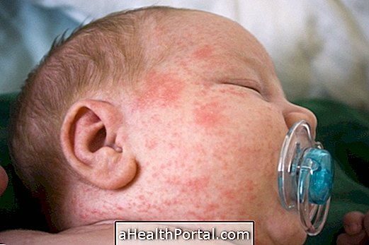 מחלות עור - כתמים אדומים ועור מגרדים עשויים להצביע על אלרגיה לחום