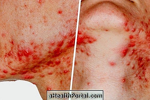 Hvad forårsager og hvordan man behandler acne fulminant