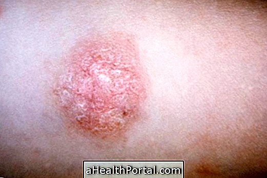 What causes and how to treat pityriasis rosea