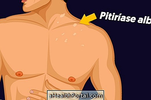 Ce este Pityriasis alba și Cum să tratezi