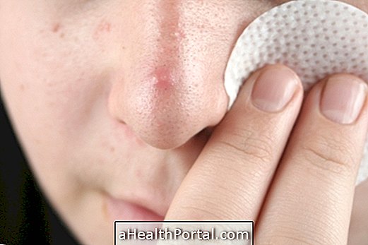 Как да почистите акне кожата