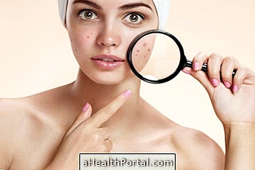 Mikä aiheuttaa pimples?
