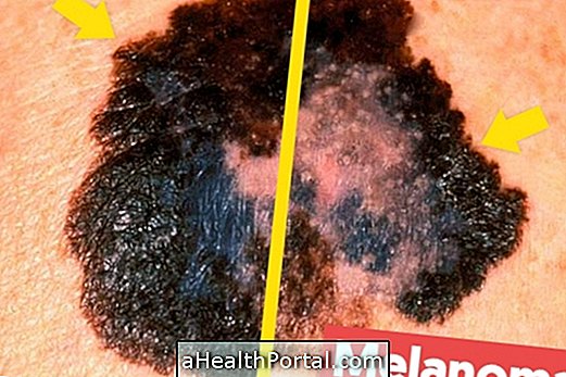 Hvordan man identificerer et melanom