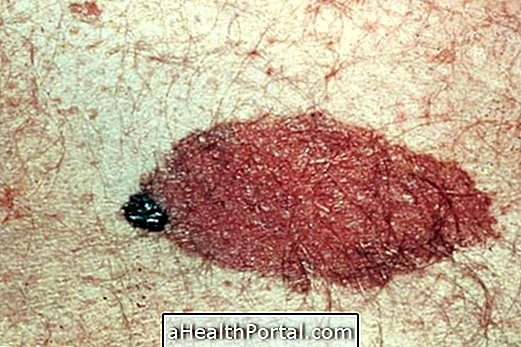 Ce este melanomul și cum să îl tratați