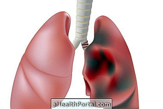 Adakah Penyembuhan Kanser Paru-paru?