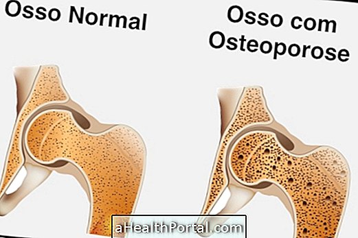 Understand Osteoporosis and Its Causes
