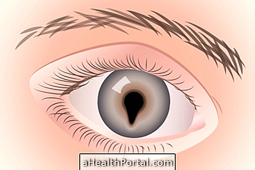 Mis on silma koloboom ja kuidas seda ravida