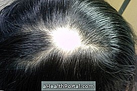 Finn ut hvordan Alopecia areata behandling er ferdig