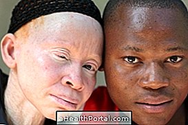 Parem mõista, mis on albinism