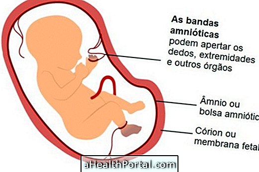 Hva er og hva som forårsaker amniotisk båndsyndrom