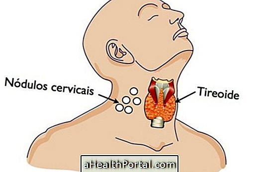 Pembedahan Tiroid: Jenis, Bagaimana Ia Dilakukan dan Pemulihan