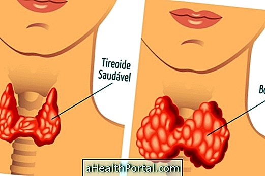 Goiter - What It Is and What the Symptoms