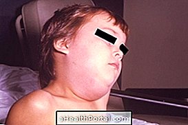 A mumpsz: a tünetek és hogyan kap