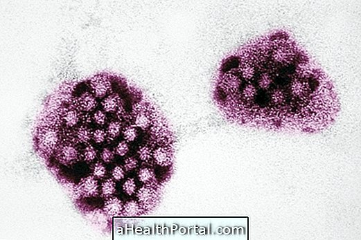 Norovirus: mitä se on, oireet ja hoito
