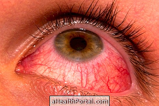 How many days does conjunctivitis last?