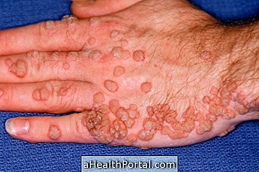 Warts are contagious - Learn how to protect yourself