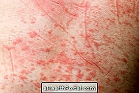 Symptome und Behandlung von hämorrhagischem Dengue-Fieber